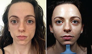 Before and after images of “Brenda,” who was born with HIV. Pierone has treated her for lipoatrophy through a three-year study using the filler Bellafill.